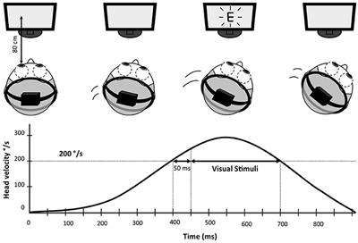 Bilateral Vestibulopathy: Vestibular Function, Dynamic Visual Acuity and Functional Impact